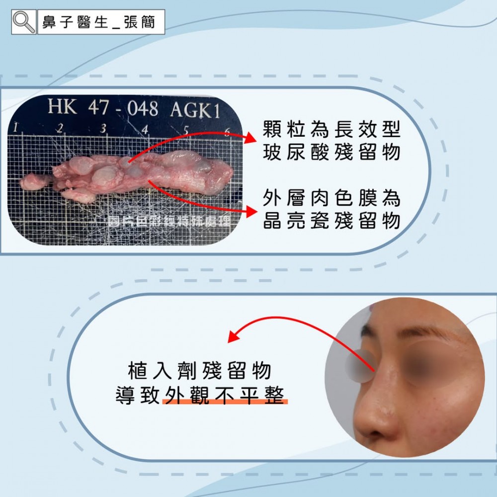 玻尿酸隆鼻注射誤殘留清除,鼻重修,博恩妍